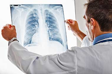 Die Symptome einer Pneumokokken-Pneumonie gleichen anfangs denen einer normalen Erkältung. Das Röntgenbild zeigt, ob die Lunge in Mitleidenschaft gezogen ist. Foto: djd/Pfizer Deutschland/Minerva Studio - Fotolia.de